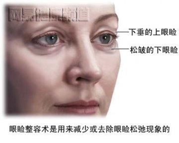 去眼袋手术