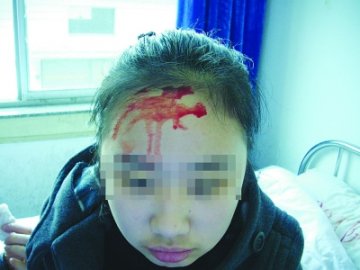 13岁女孩患罕见“血汗症”舌部额头等会出血