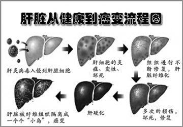 第二军医大学肝炎肝癌课题组最新成果为肝癌病人送去福音