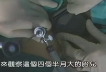 实拍少女人流全过程