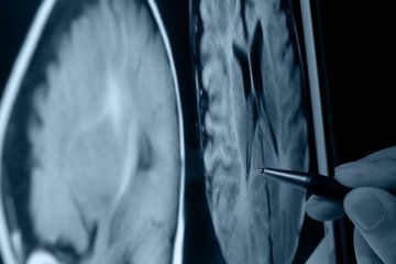 科学家把普通皮肤细胞转变成大脑神经细胞