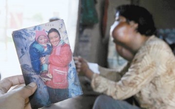 40岁农妇脸上长7肿瘤 为支撑家庭不放弃生活