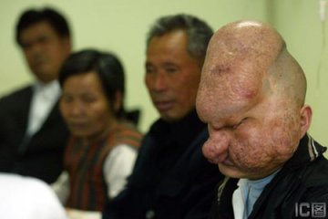 狮面人今日换头盖骨 手术备有两种方案