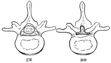 腰椎管、根管扩大减压术