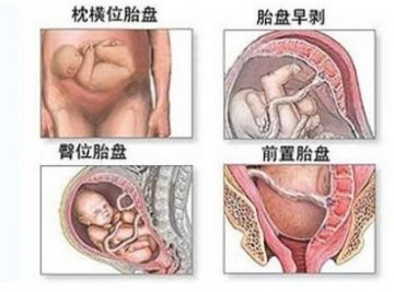 医学实录：女性剖腹产手术全过程
