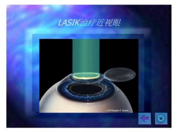 lasik14