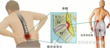 世界脊柱健康日：这些脊柱问题你了解么？