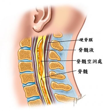 顾建文：肢体麻木乏力警惕脊髓病变