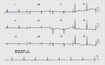 低钾血症Hypokalaemia