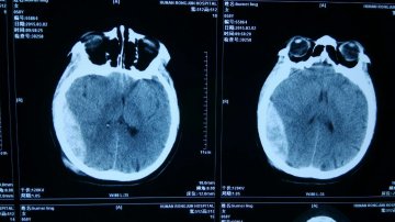 医院成功救治重度颅脑损伤患者