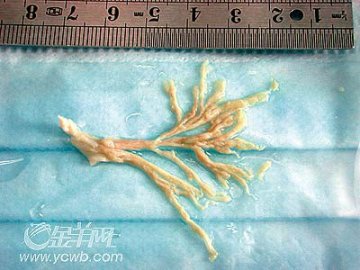 罕见致命性支气管炎袭击广州三儿童