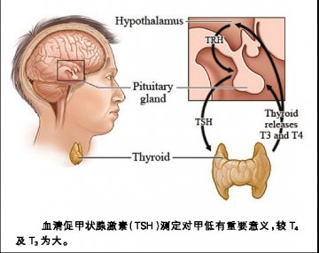 中年女性“发福” 警惕甲减来袭