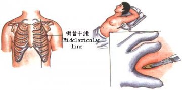 胸膜腔闭式引流术