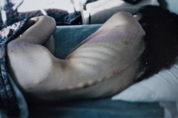 实拍厌食症患者的身体