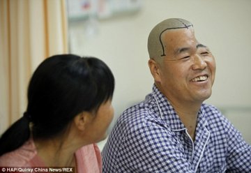 西京医院用3D打印的钛网颅骨重建“半头人”头部