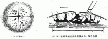 痈