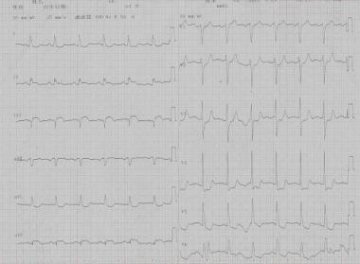 急性ST段抬高性心肌梗死Guardwire支持下直接PCI
