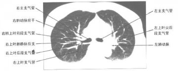 正常胸部肺窗CT（2）