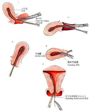 女性上避孕环全过程