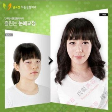 31个惊人韩国整容案例