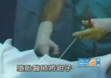 实拍堕胎手术全过程 呼吁珍惜生命