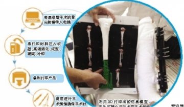 粉碎性骨折？3D打“印”出“新骨头”！