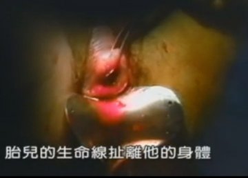实拍：美国堕胎手术全过程