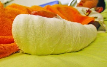 少年被树桩绊倒手指插进碎玻璃 血管肌腱被割断