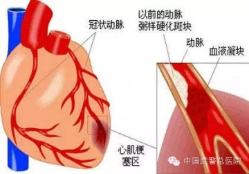 “心梗”盯上年轻人 天冷更需防范
