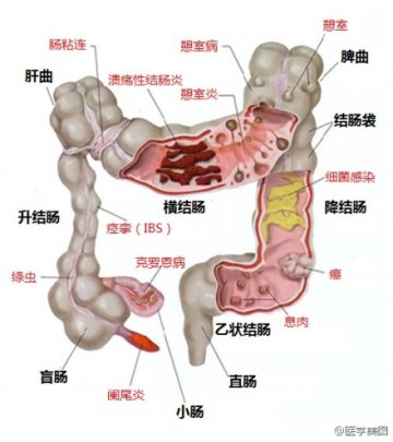 信息图：结肠常见疾病