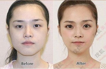 31个惊人韩国整容案例