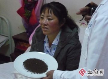 女子胆囊内取出11688颗结石