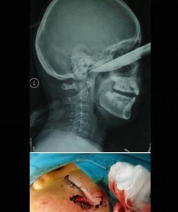 瞠目结舌X光片：女人下体都能放点儿啥