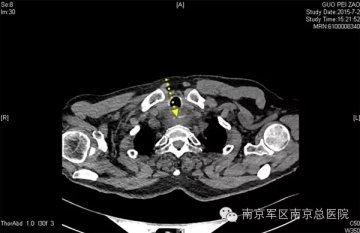 南京总医院分秒必争救治高龄食道异物患者