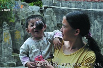 两岁幼儿患血管瘤 左眼肿瘤大如鹅蛋