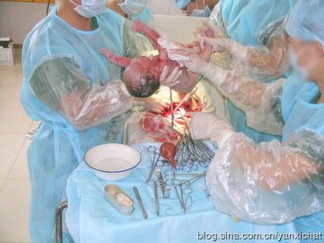 女性很伟大！惊心动魄剖腹产全程