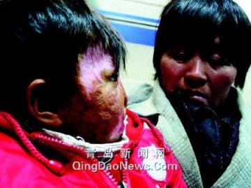 父母千里行乞为毁容爱女筹资换脸