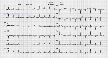 电交替Electrical Alternans