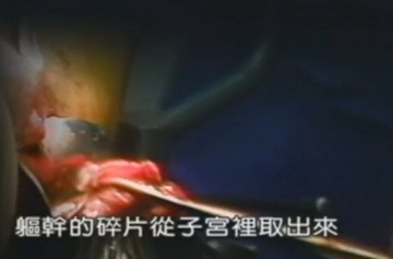 实拍少女人流全过程