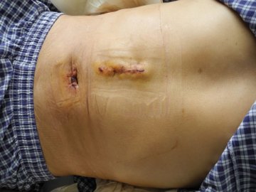 西京消化病医院成功实施西部首例单孔腹腔镜辅助胃癌根治术