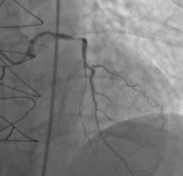 CABG术后LM及LAD严重钙化病变的PCI