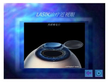 lasik15