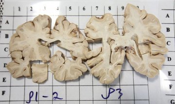 揭秘人脑解剖全过程