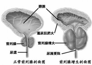 多练提肛，保护前列腺