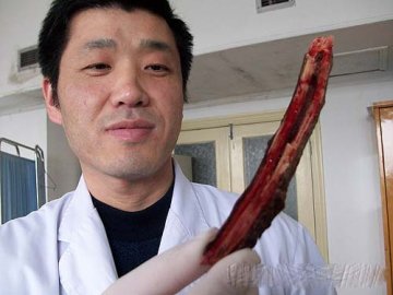 全球最怪异人体：肺里能长树