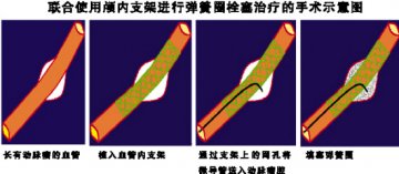 关注动脉瘤 清除脑中炸弹