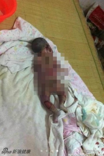 网曝福建泉州疑被医院保温箱烫死婴儿事件