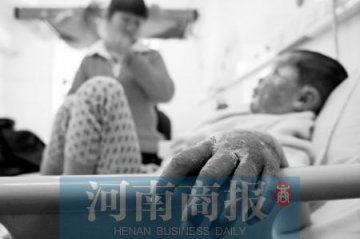 7岁男孩误把浓硫酸洒在身上 五官变形鼻子不保