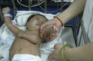 两月大男婴长3手臂 手术成难题图