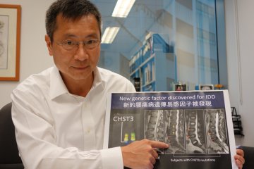港大发现基因决定腰背痛